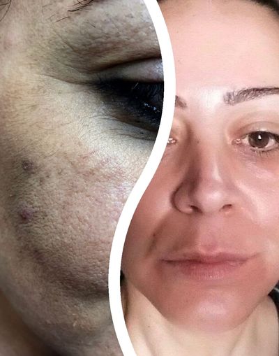 Before & After images of a ZO 3 step chemical peel!
(1 course of 3 treatments)