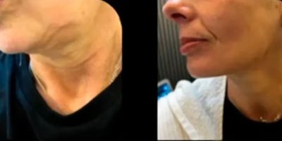 7 Hifu (High Intensity Focused Ultrasound)
Before treatment 1 & after treatment 1