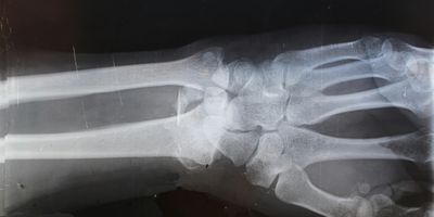 X-ray image of a human wrist showing bones and joints.