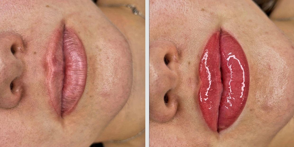 Avant: Ligne de contour
Après : Résultat final. Cliente perdra 30-50% du pigment.