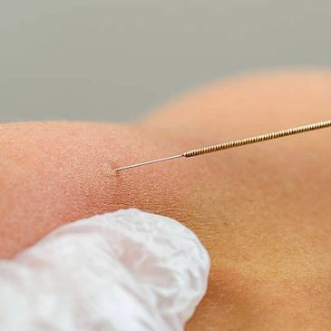 Dry Needling Now Available! 