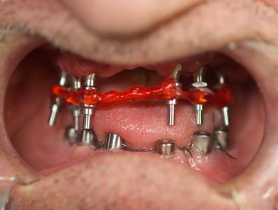 High Quality, Affordable Prices
If you are missing one or more teeth, dental implants are the choice
