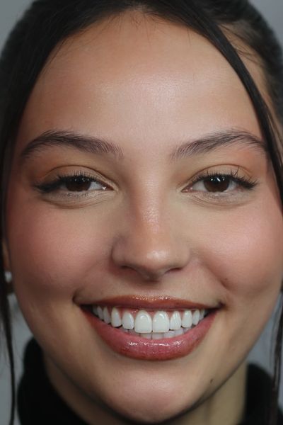Smile Transformation