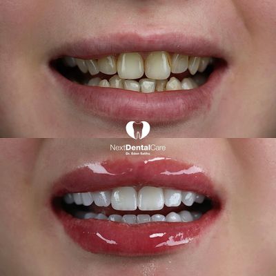 Before and after dental makeover showing improved teeth and glossy lips.