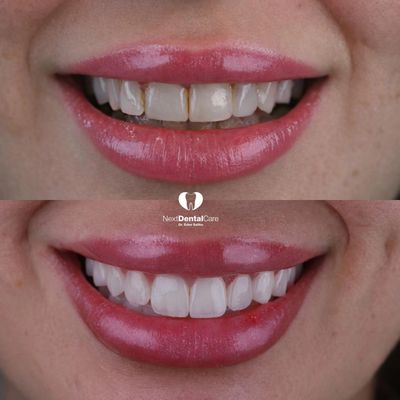 Before and after dental veneers showing a dramatic smile transformation.