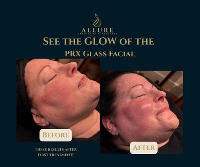Before and after images showcasing the glow from the PRX Glass Facial treatment at Allure Aesthetics & Wellness.