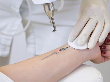 Lasers works to remove tattoos by breaking up the larger ink particles into pieces small enough for 