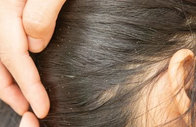 Close-up of scalp with visible dandruff flakes in dark hair.