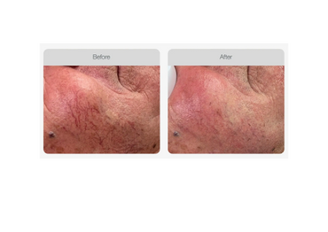 IPL treatment perth of broken blood vessels and redness 1 treatment results