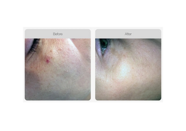 Vascular Cherry Angioma Treatment - 1 treatment results