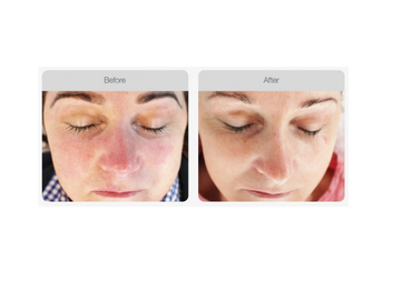 IPL Treatment of redness and broken blood vessels - 5 treatment results