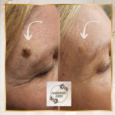 Cryotherapy Removal