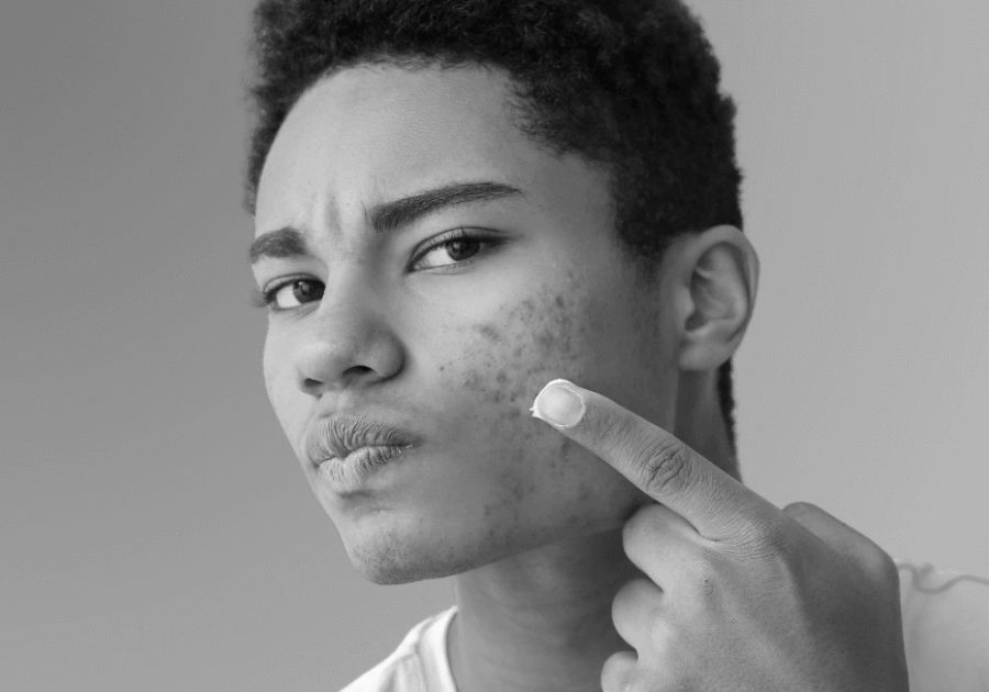 Black and white portrait of a young man pointing to acne on his cheek.