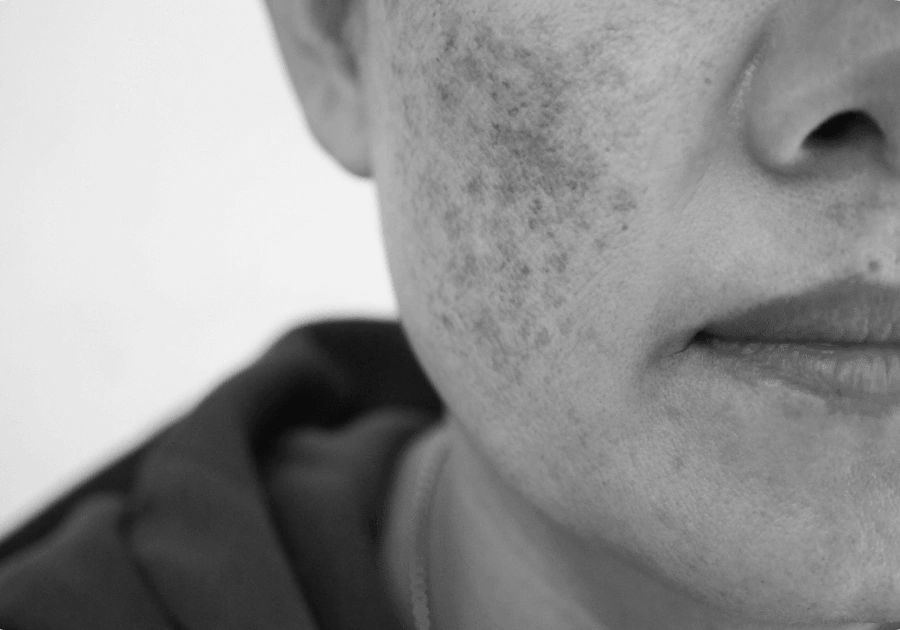 Black and white close-up of facial skin showing areas of pigmentation on the cheek.