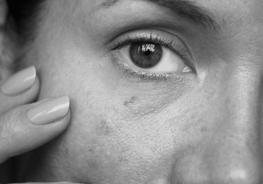 Black and white close-up of facial skin showing visible vascular lesions near the eye.