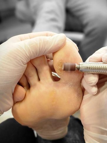 Use of a podiatry drill to reduce callus