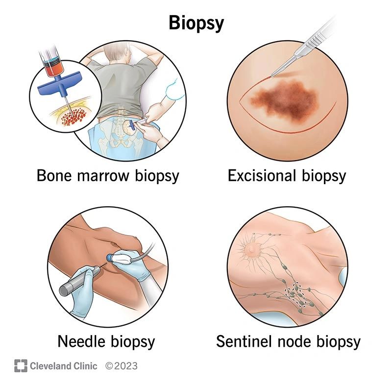 Neurologist, biopsy and medicine trial