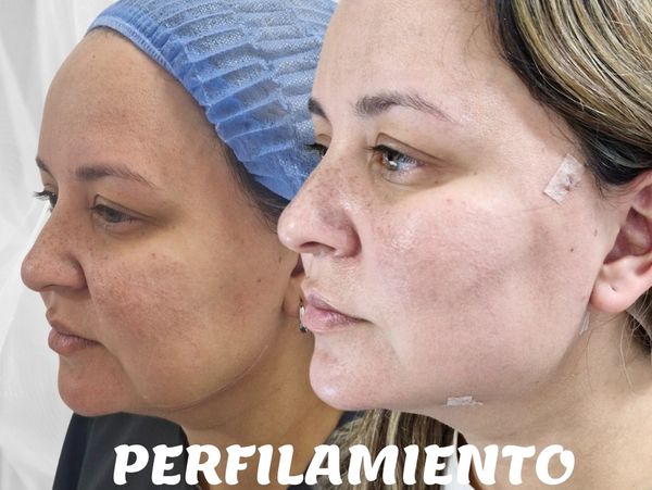 caso real de lifting no quirurgico en cali con la dra bianca ariza en stetic renova 