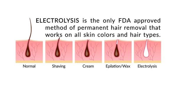 FDA Approved Method for Hair Removal