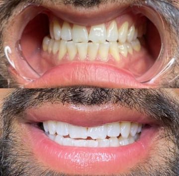 TEETH WHITENING 