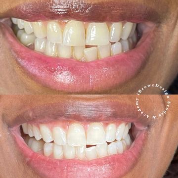 BASIC TEETH WHITENING