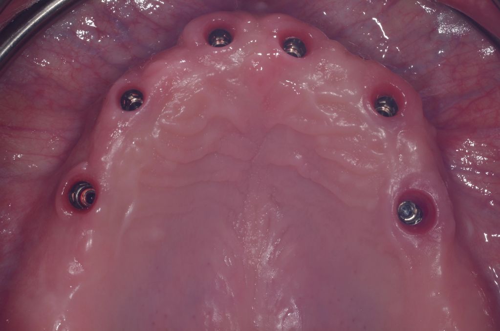 All on 6 dental implant bridge
