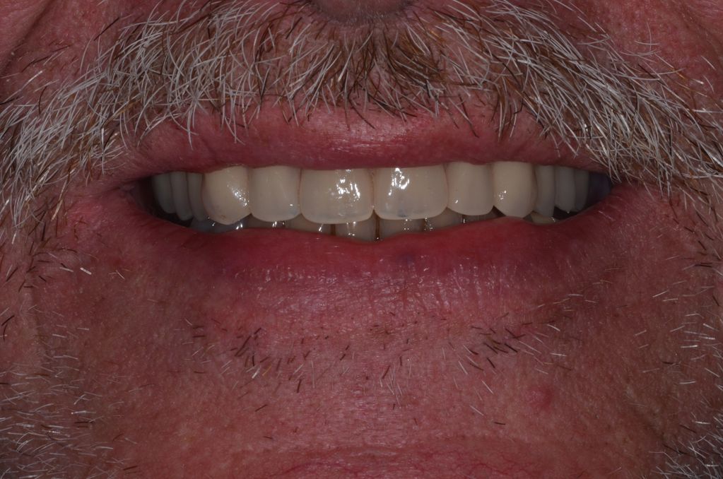 full arch dental implant