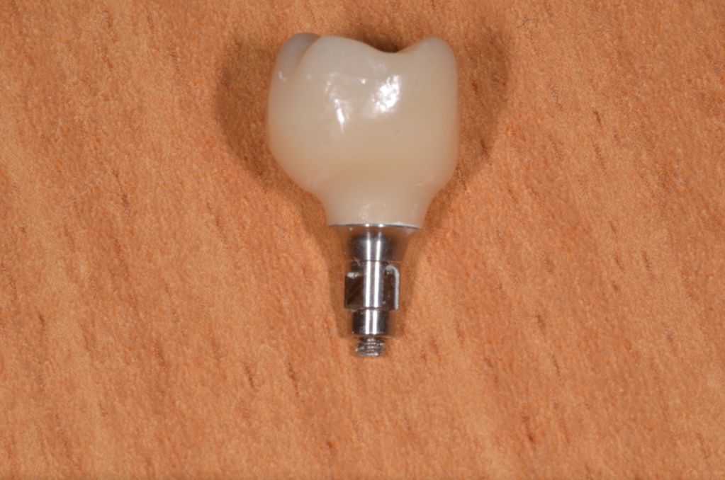 screw retained dental implant crown