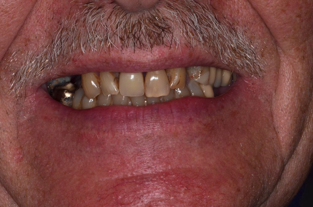 Failing teeth through gum disease