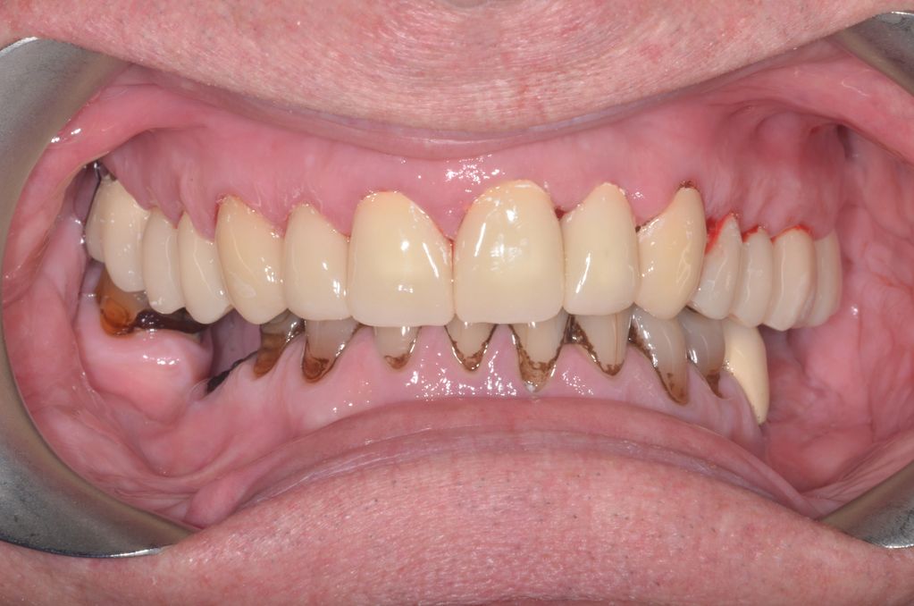 Temporary dental crowns to restore a full arch of teeth