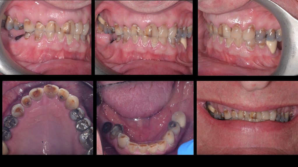 Broken down and worn teeth