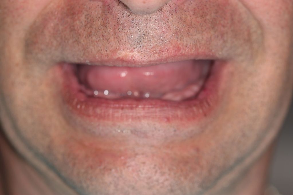 Missing teeth 