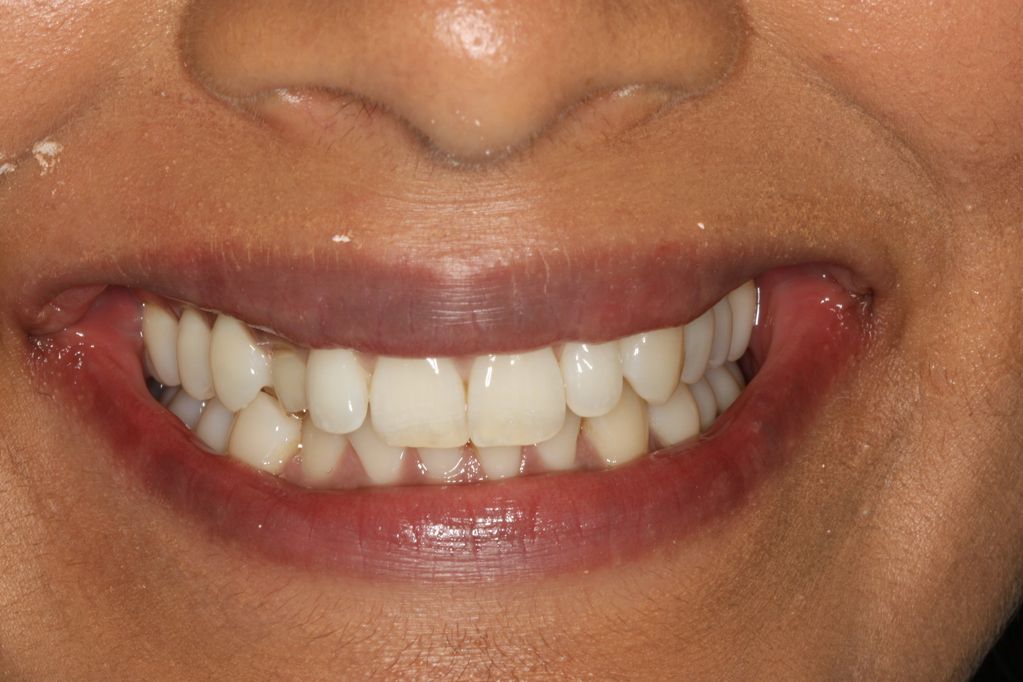 Aesthetic zone dental implant pre-op photograph