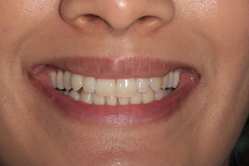 Aesthetic zone dental implant blending in to a natural smile