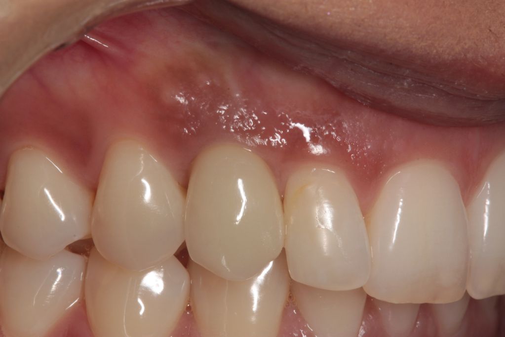 Aesthetic zone dental implant with natural gum contours and high aesthetic dental crown