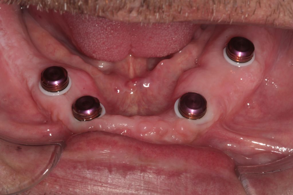 implant retained dentures with locator abutments