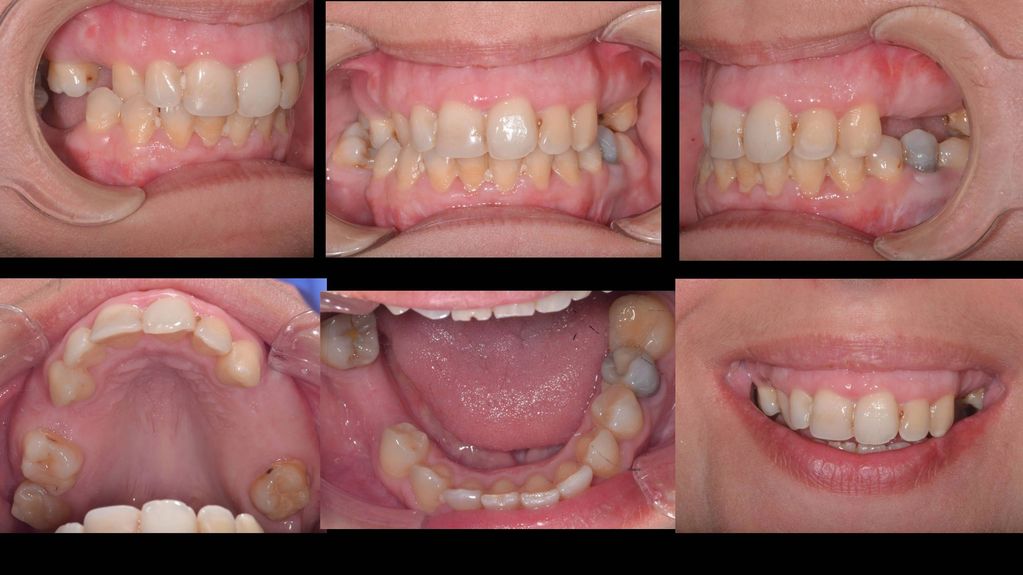 multiple tooth gaps with a discoloured natural tooth