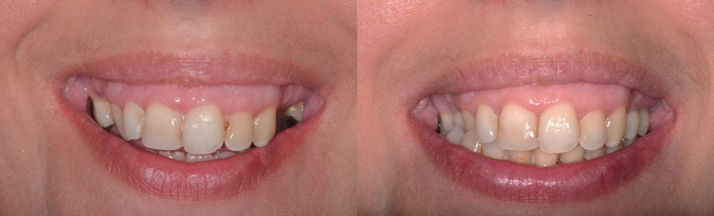 comparing smile before implant treatment and after successful implant treatment