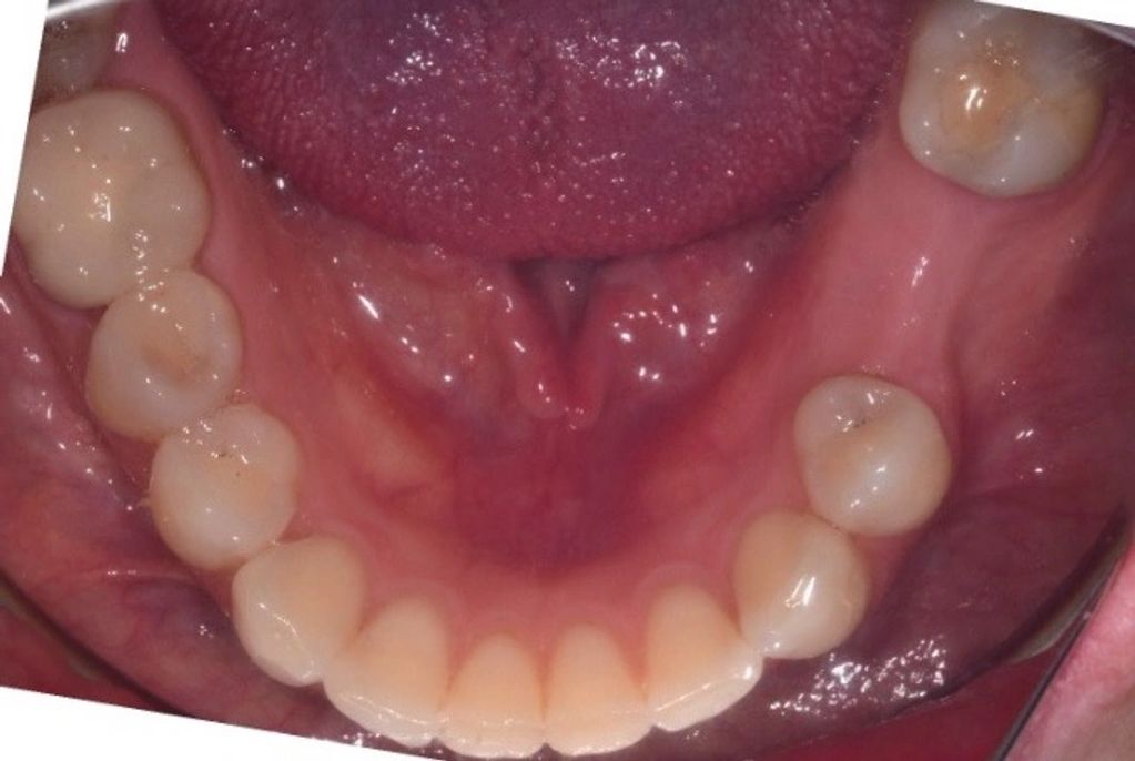 single missing lower molar tooth
