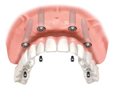 Full arch all on 4 implants 
