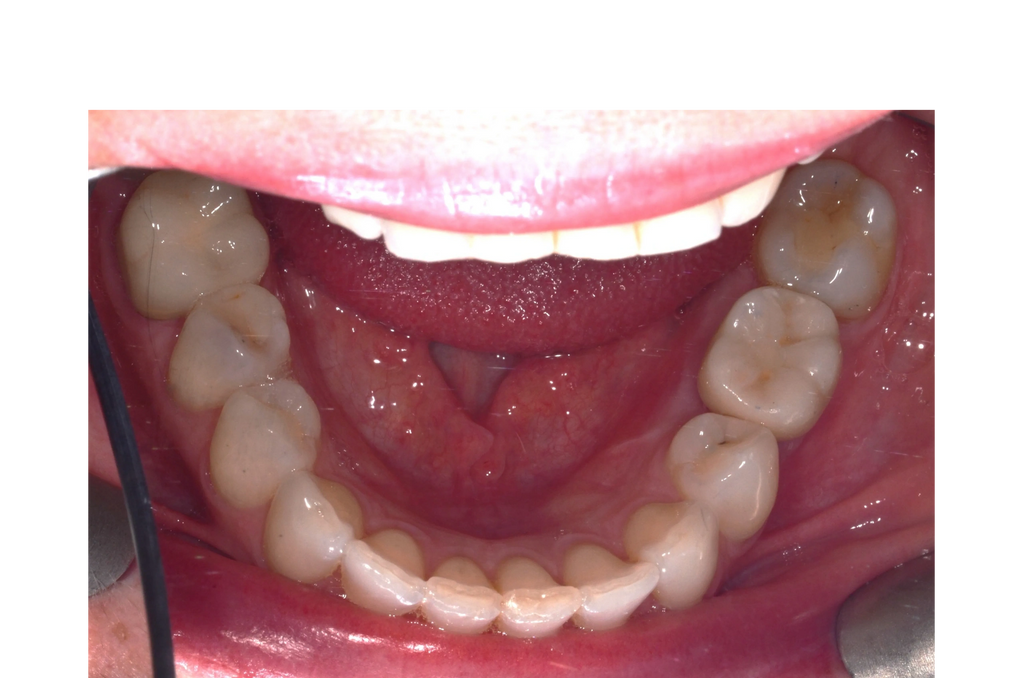 successful replacement of the lower first molar tooth with a dental implant