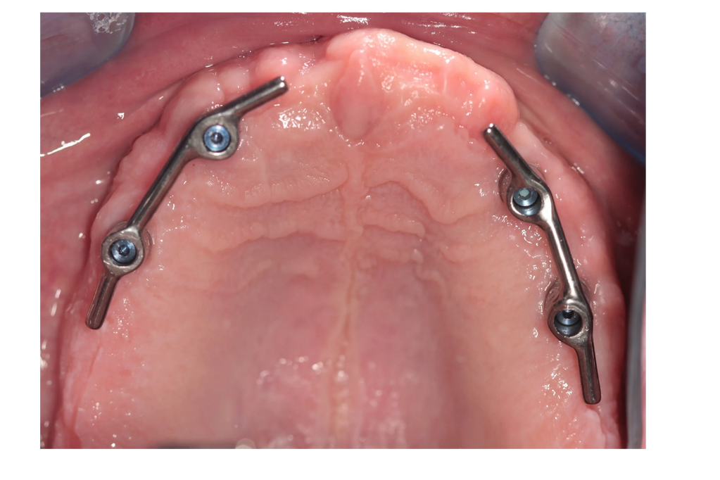 Implant retained overdenture with bar retention