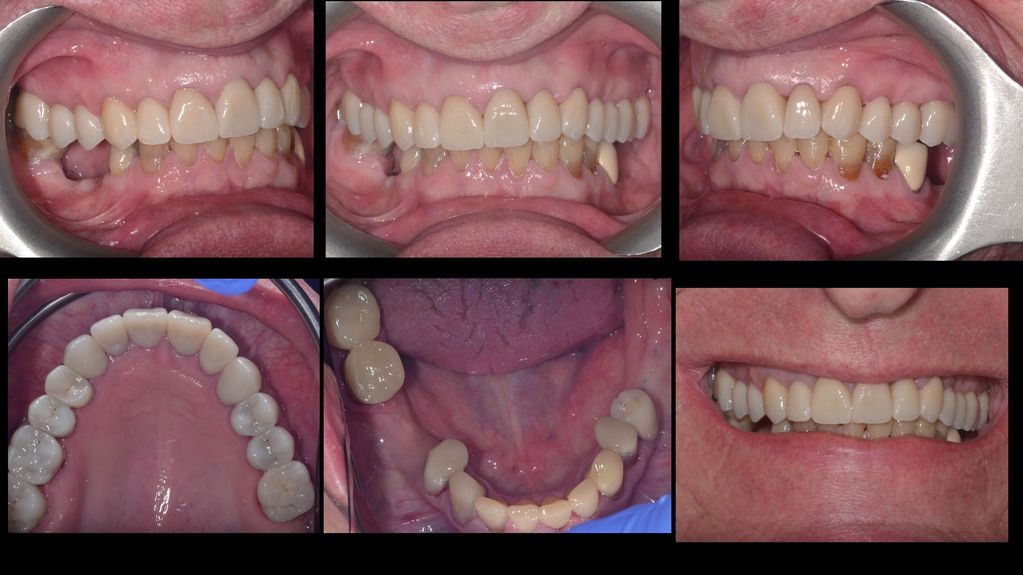 Final high aesthetic result of dental crowns rather than sacrificing teeth for dental implants