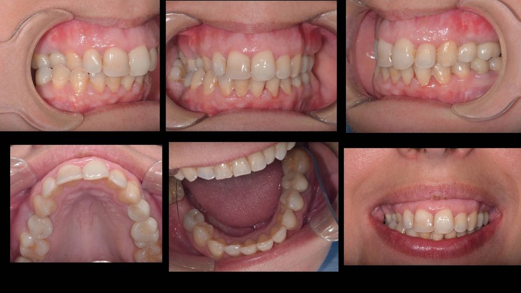 dental implants were performed to restore the missing teeth with a dental crown 
