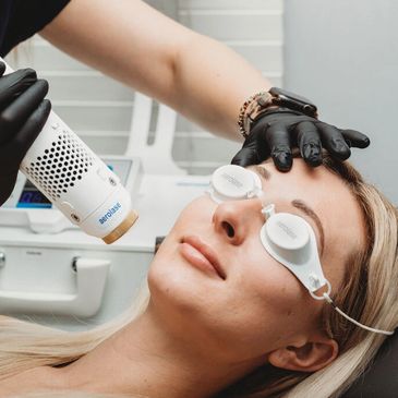 laser treatments