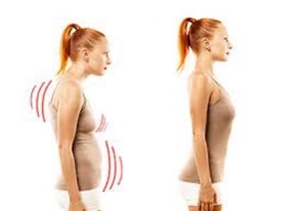 Female with bad posture, before/after pic. Rolfing at Palm Beach Pain Relief in FL improves posture.