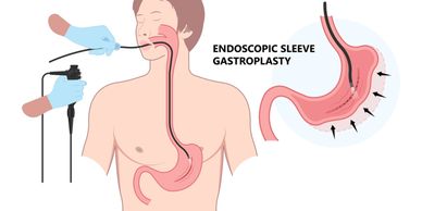 Ilustración de gastroplastia en  manga endoscópica.