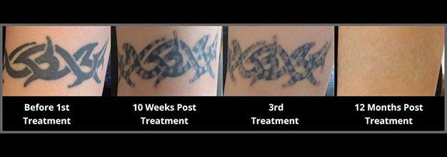 Tattoo lightening or remove permanent makeup in White Iris Salon in Clearwater, in Tampa