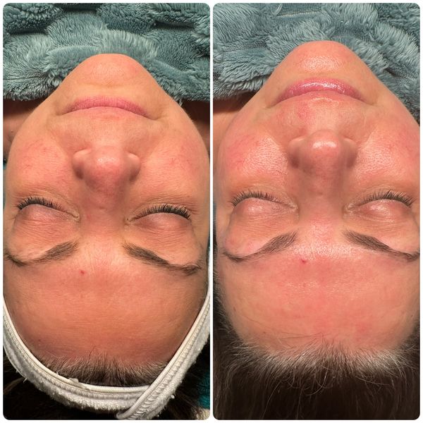 Ultimate Skin Renewal