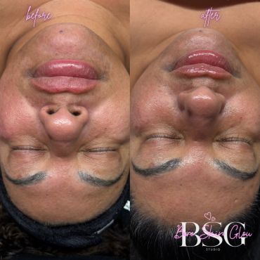 Before and after facial treatment comparison.